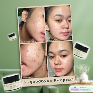 Bye Bye Jerawat & Bekas jerawat 🍂 

Kunci dari kulit sehat dan terawat adalah memilih skincare yang tepat dan konsistensi. 
Lihat apa yang custumer ini dapatkan setelah 8 minggu. Amaizing 🤩✨

#yufaderma #backtohealthyskin #yufadermatestimoni